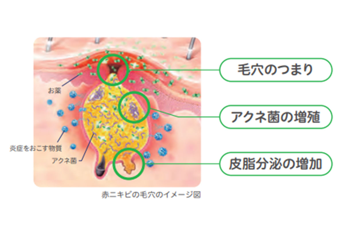 ループスを発症するリスクがあるのは誰ですか?